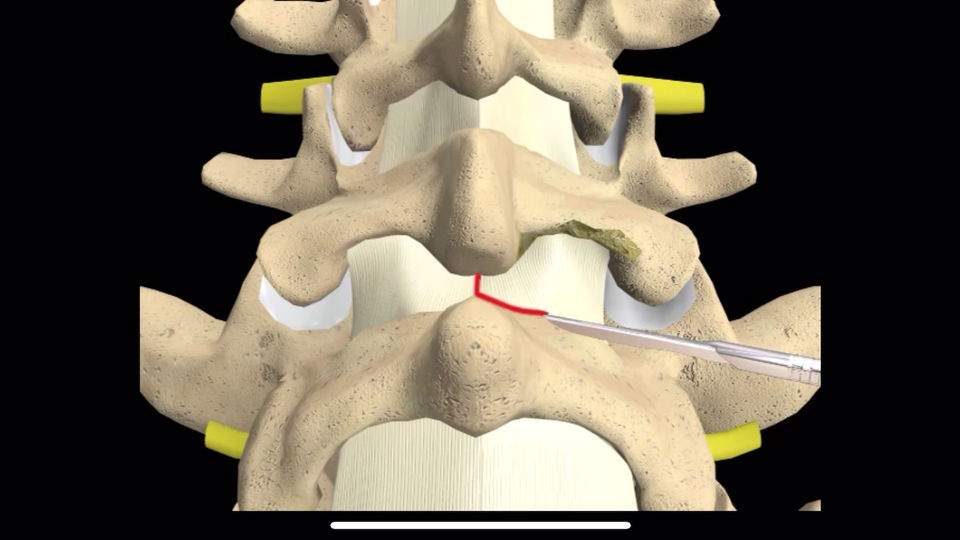 Discectomy Posterior Technique